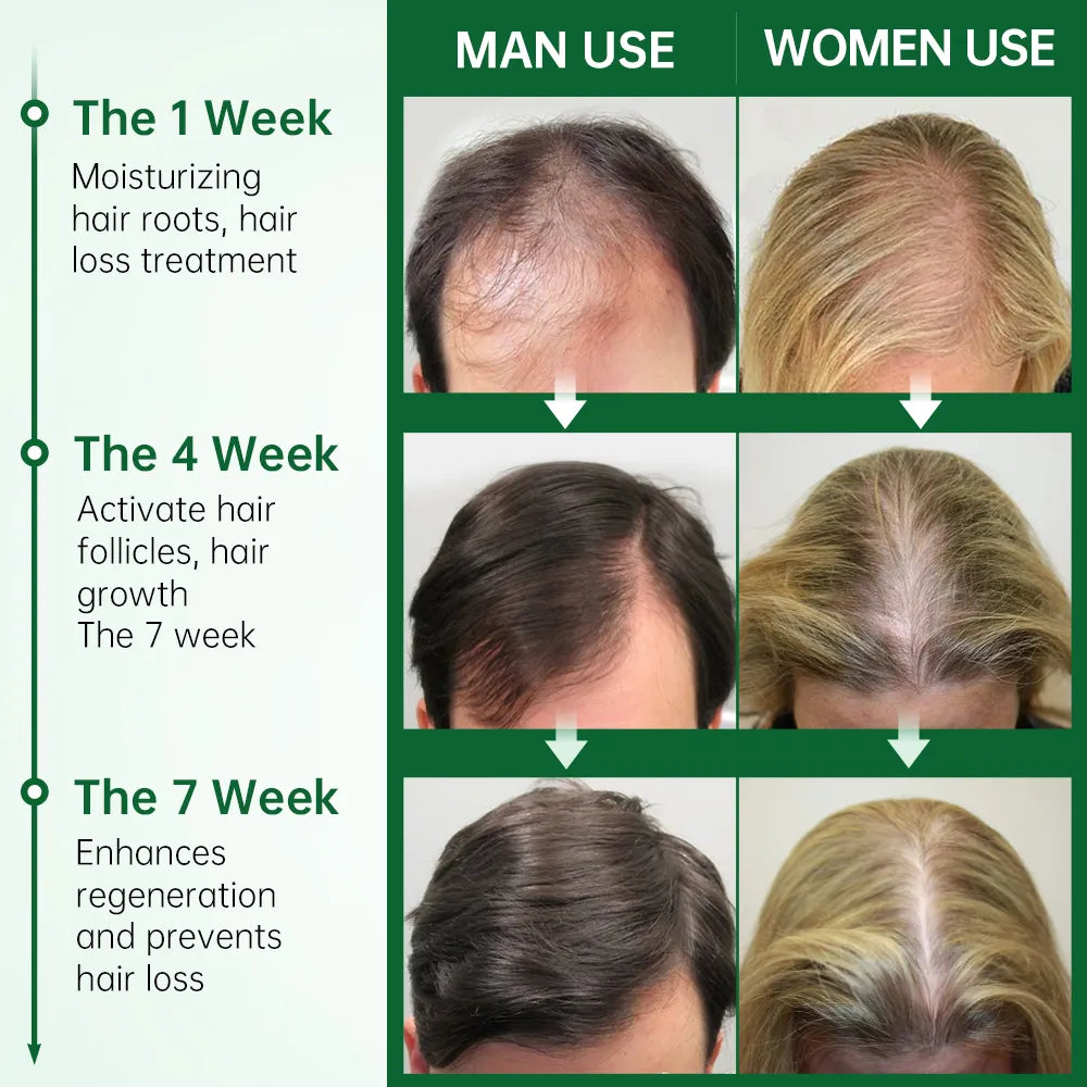 PURC Rosemary Oil For Hair Growth Anti Hair Loss