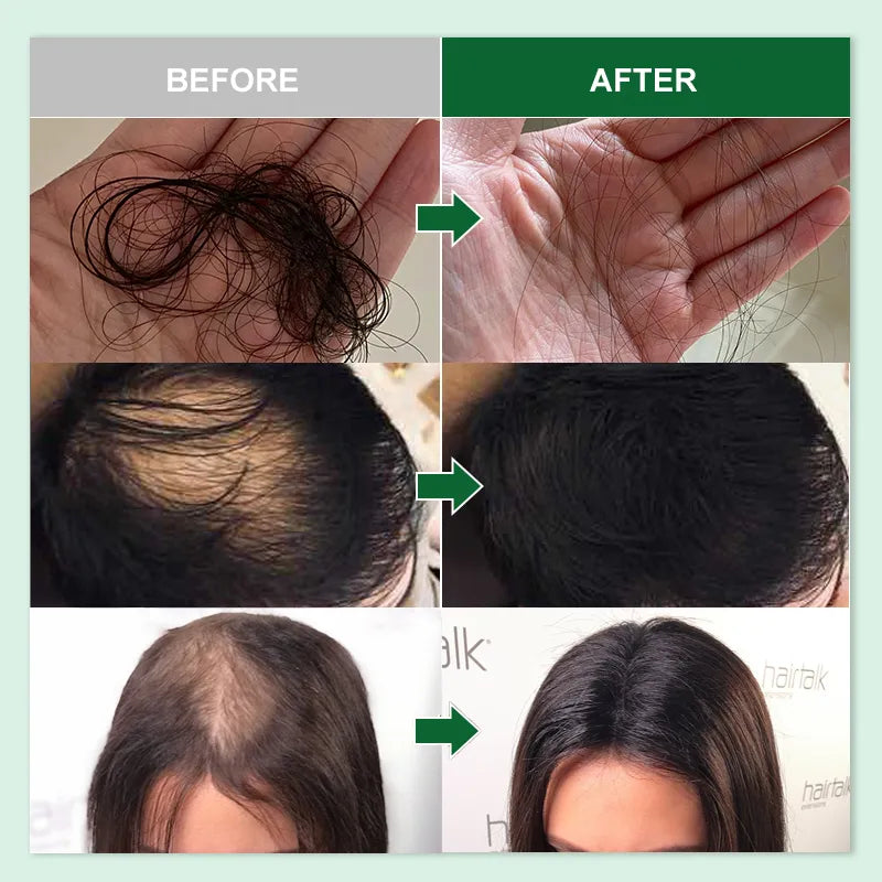 PURC Rosemary Oil For Hair Growth Anti Hair Loss